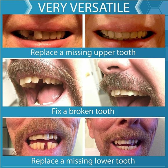 Instant Smile Complete Your Smile Temporary Tooth Replacement Kit 40 Fake Teeth - Picture 7 of 7
